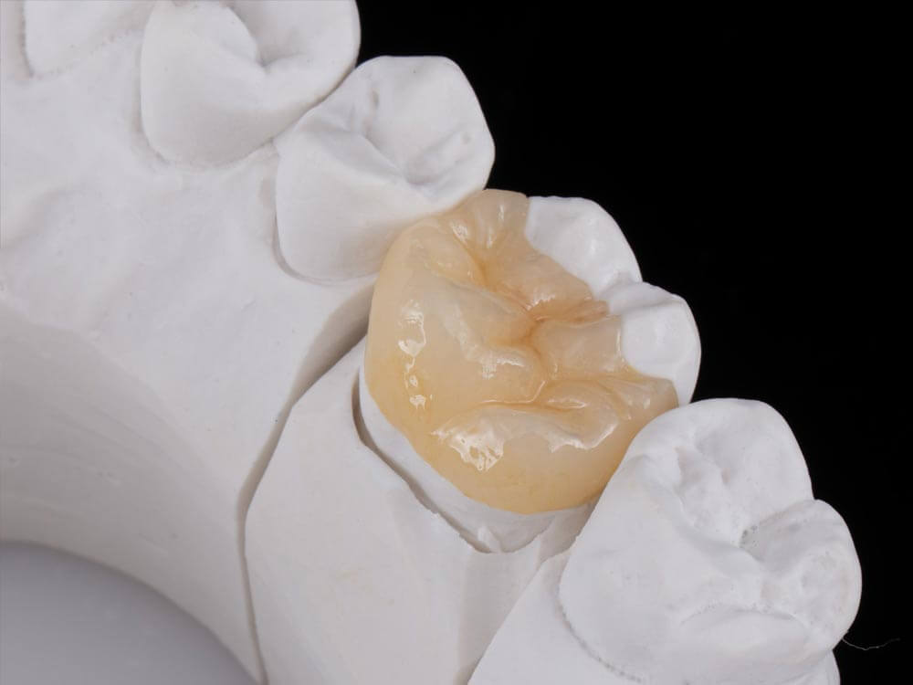 Onlay/Inlay/Overlay, prothèses fixées proposées à la Clinique FluOr à Bienne en Suisse